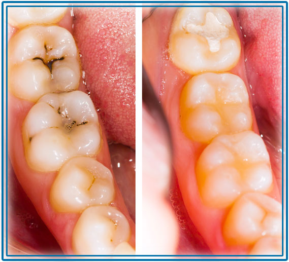 Side by side example of fillings in teeth